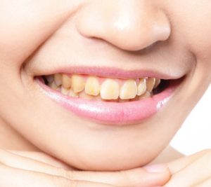 Periodontal Therapy | Mountainside Dental Care | Oro Valley AZ